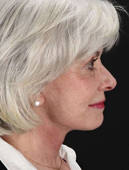 Neck Lift Before & After Patient #6665