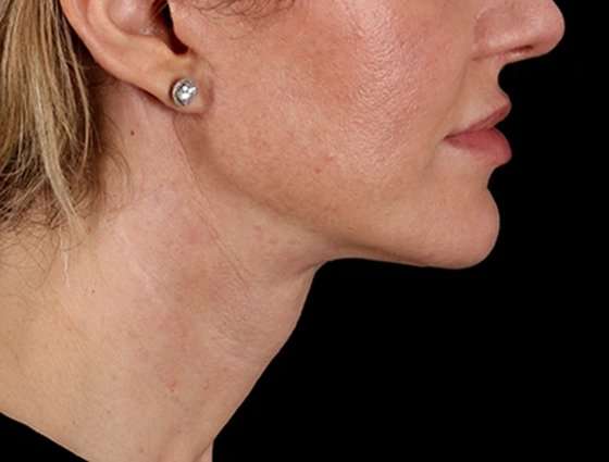 Neck Lift Before & After Patient #6676