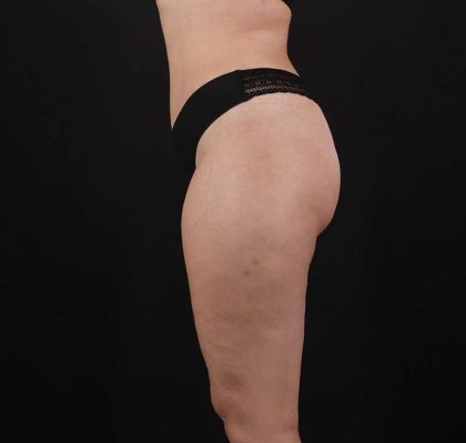 Liposuction Before & After Patient #1249