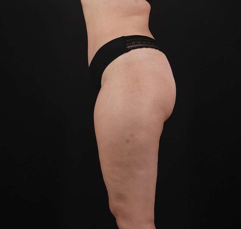 Liposuction Before & After Patient #1249