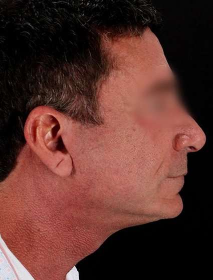 Neck Lift Before & After Patient #6698
