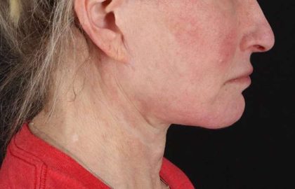 Neck Lift Before & After Patient #6731