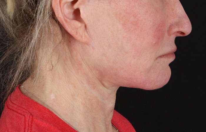 Neck Lift Before & After Patient #6731