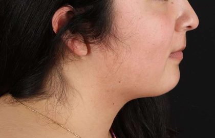 Neck Lift Before & After Patient #6743