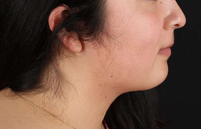 Neck Lift Before & After Patient #6743