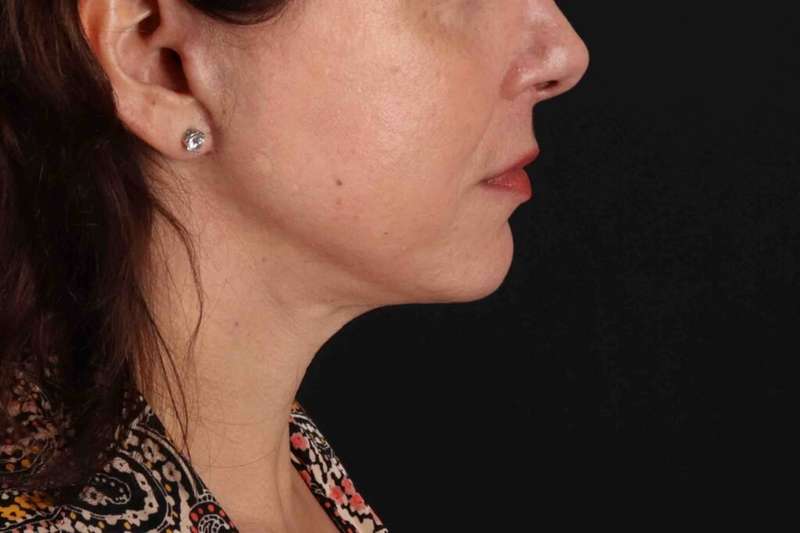 Neck Lift Before & After Patient #6797