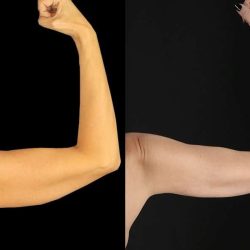 Liposuction Before & After Patient #1256