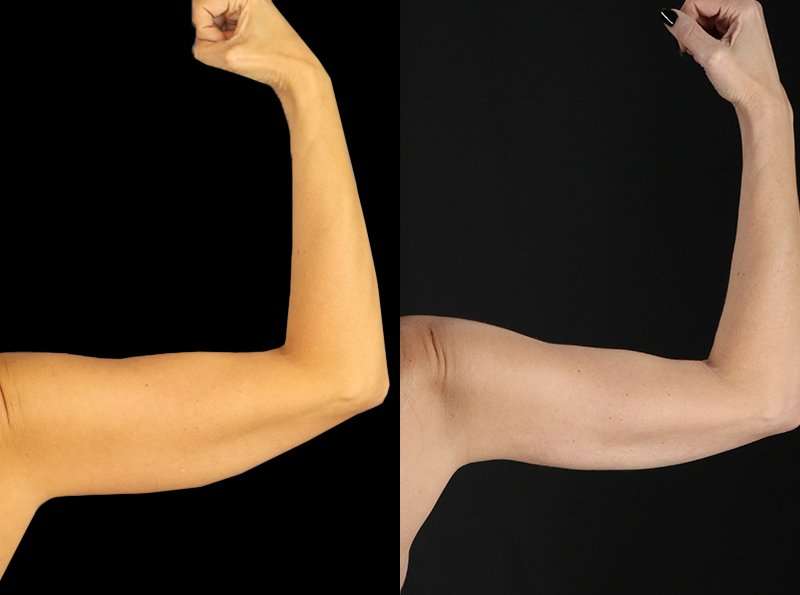 Liposuction Before & After Patient #1256