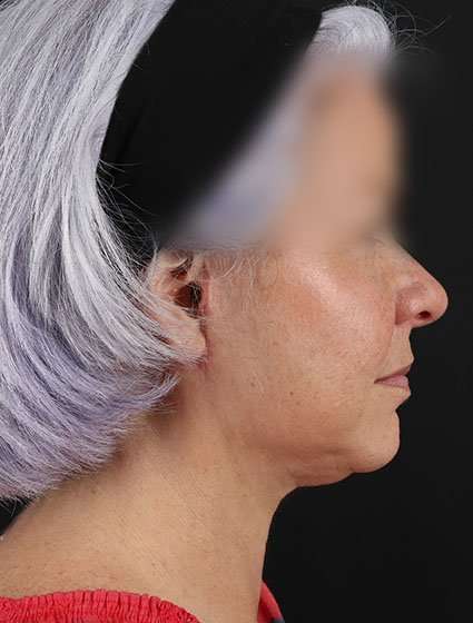 Neck Lift Before & After Patient #6878