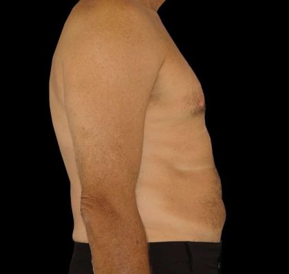 Liposuction Before & After Patient #1270