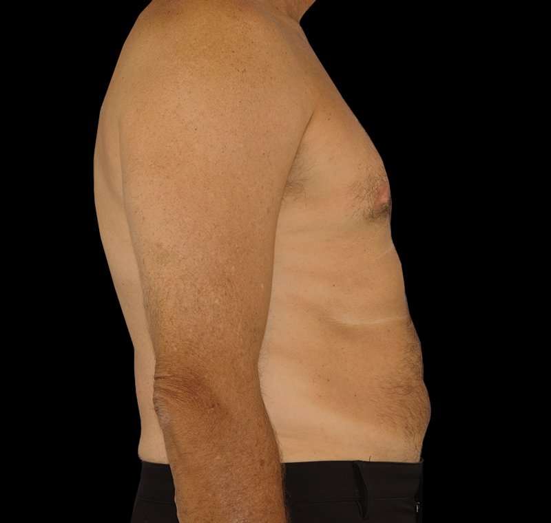 Liposuction Before & After Patient #1270