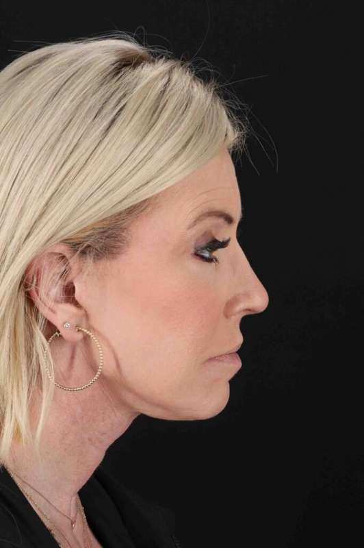 Neck Lift Before & After Patient #6920