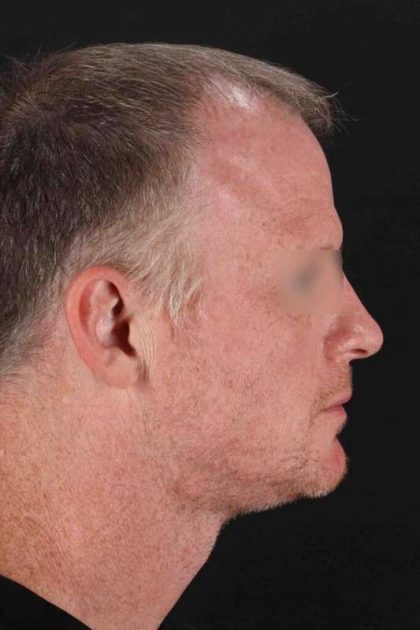 CO2 Laser Before & After Patient #6931