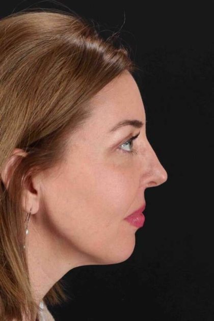 CO2 Laser Before & After Patient #6953