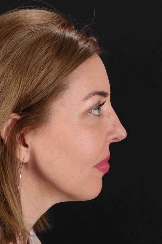 CO2 Laser Before & After Patient #6953