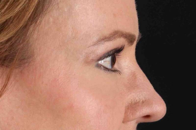 CO2 Laser Before & After Patient #6986