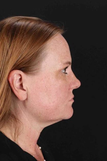 CO2 Laser Before & After Patient #6997