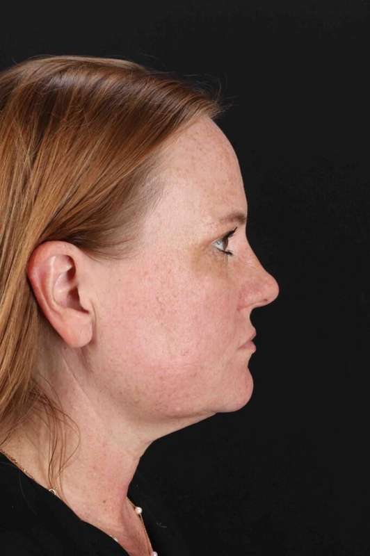 CO2 Laser Before & After Patient #6997