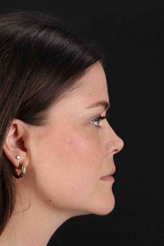 CO2 Laser Before & After Patient #7008