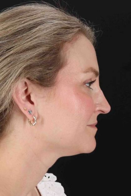 CO2 Laser Before & After Patient #7019