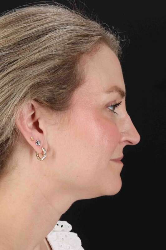 CO2 Laser Before & After Patient #7019