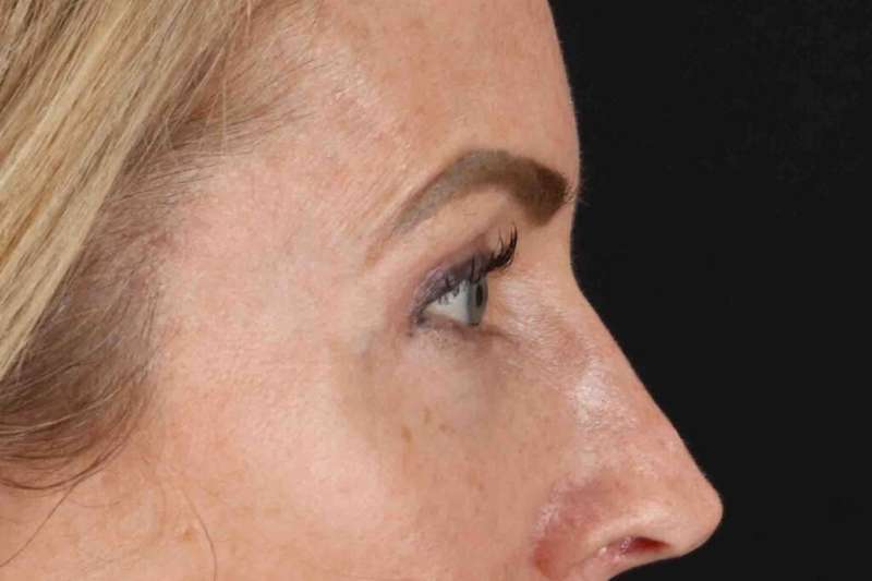 CO2 Laser Before & After Patient #7030