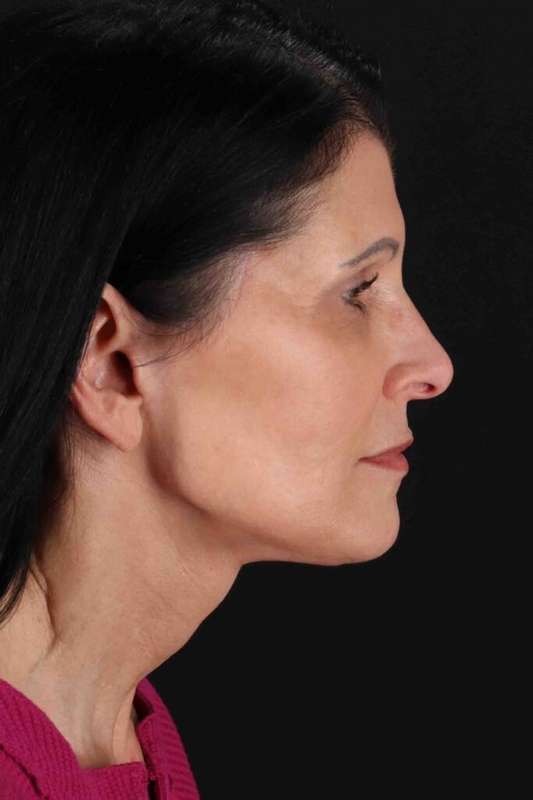 CO2 Laser Before & After Patient #7063