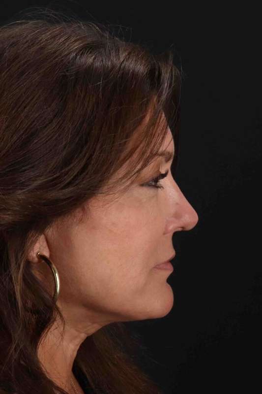CO2 Laser Before & After Patient #7085