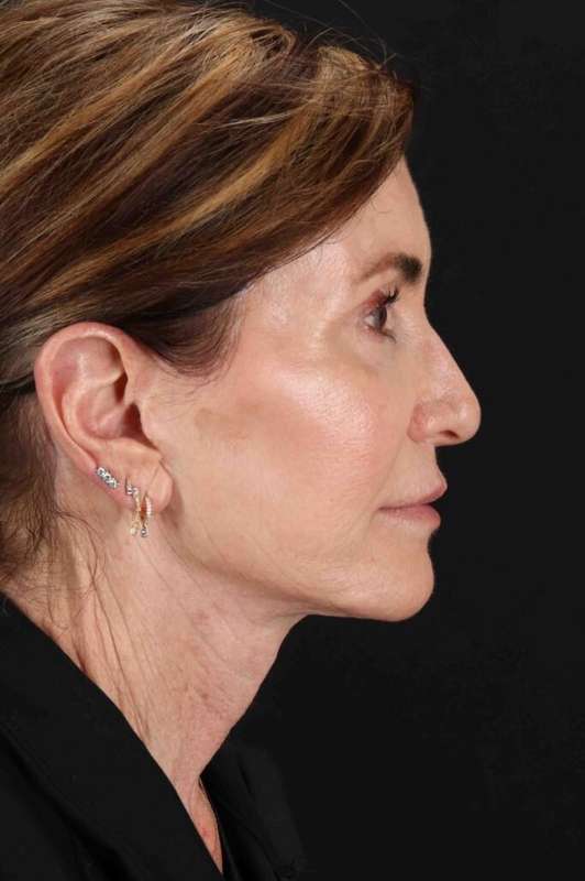 CO2 Laser Before & After Patient #7096