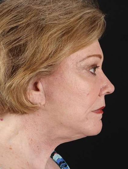 CO2 Laser Before & After Patient #7106