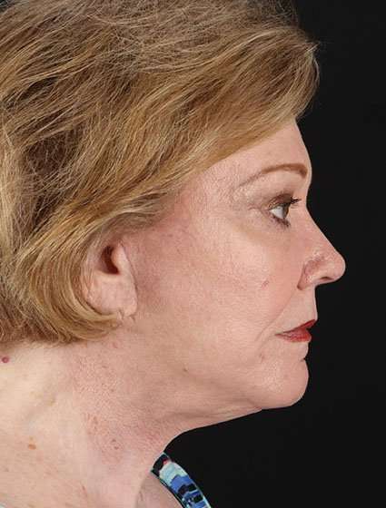 CO2 Laser Before & After Patient #7106