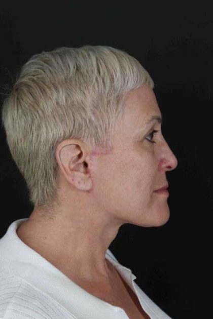 CO2 Laser Before & After Patient #7117