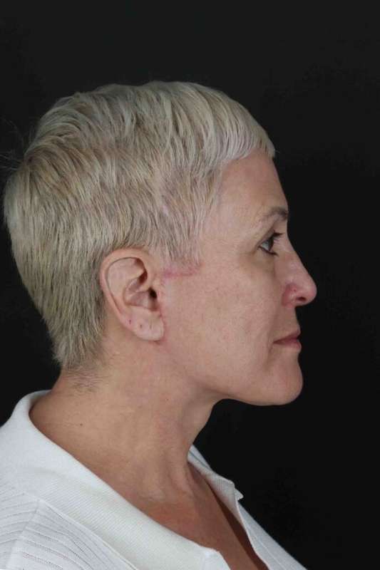 CO2 Laser Before & After Patient #7117