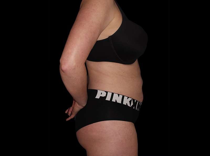 Liposuction Before & After Patient #1298