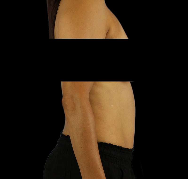 Liposuction Before & After Patient #1332