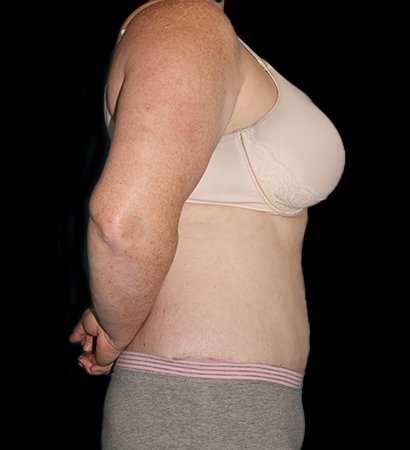 Abdominoplasty (Tummy Tuck) Before & After Patient #625