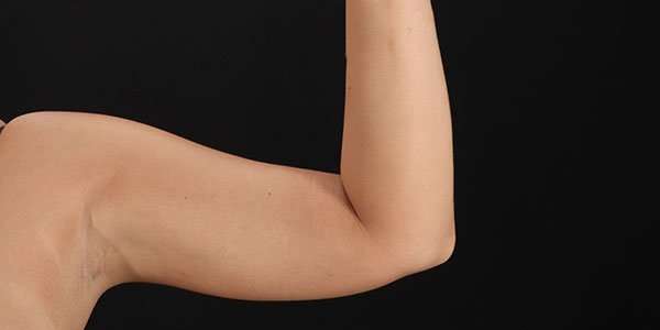Liposuction Before & After Patient #1482