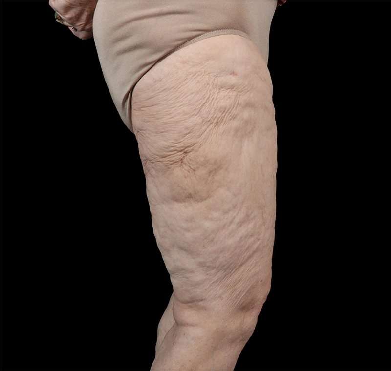 Liposuction Before & After Patient #1495
