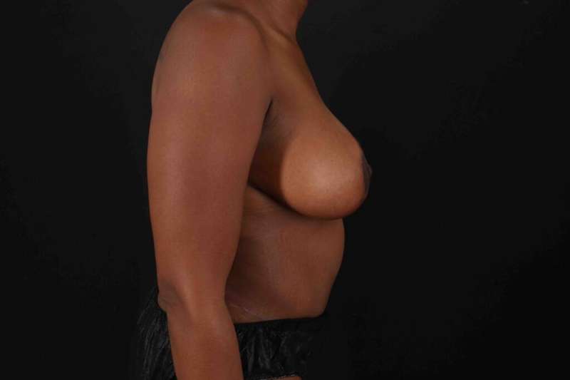 Liposuction Before & After Patient #1524