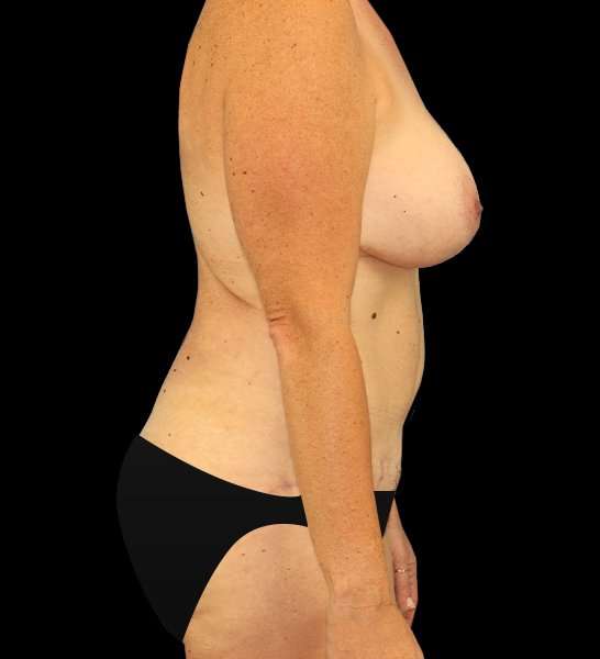 Mommy Makeover Before & After Patient #1535