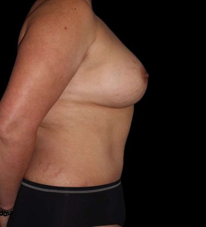 Mommy Makeover Before & After Patient #1547