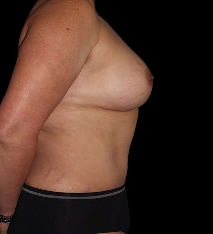Mommy Makeover Before & After Patient #1547