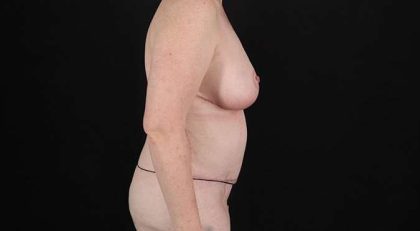 Mommy Makeover Before & After Patient #1623