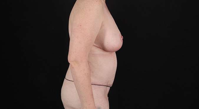 Mommy Makeover Before & After Patient #1623