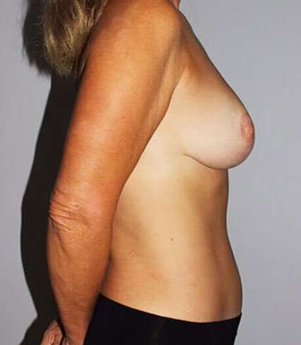 Mommy Makeover Before & After Patient #1658
