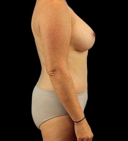 Mommy Makeover Before & After Patient #1738