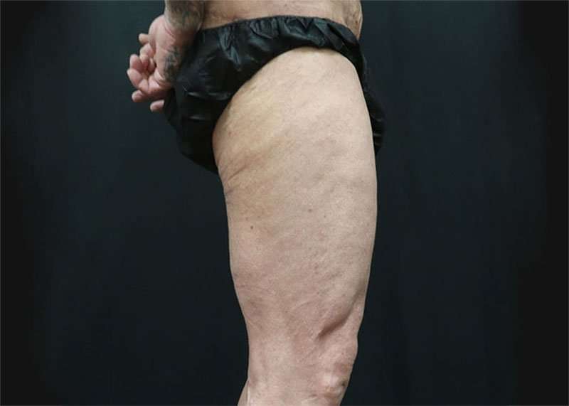 Thigh Lift Before & After Patient #1776