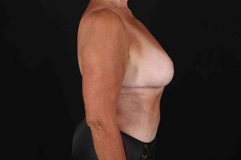Abdominoplasty (Tummy Tuck) Before & After Patient #664