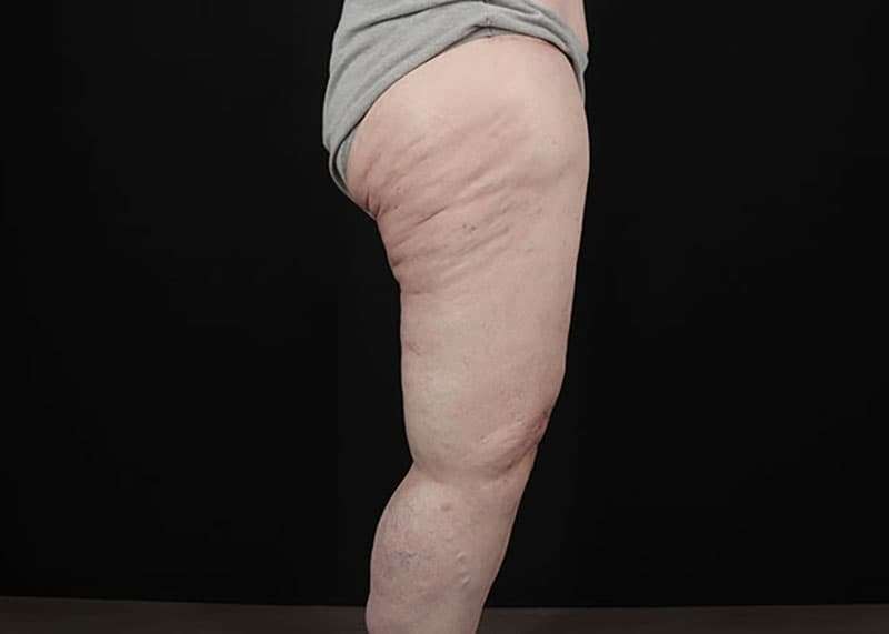 Thigh Lift Before & After Patient #1790