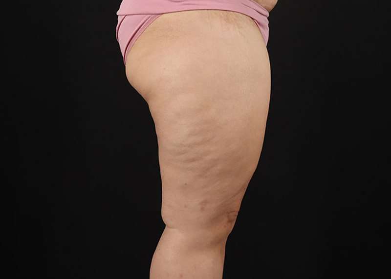 Thigh Lift Before & After Patient #1804